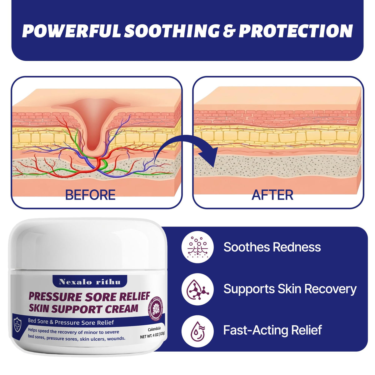 Calendula Aloe Vera Bed Sore Cream Y718917